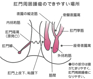 肛門周囲腫瘍のできやすい場所