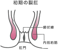 初期の裂肛