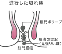 進行した切れ痔